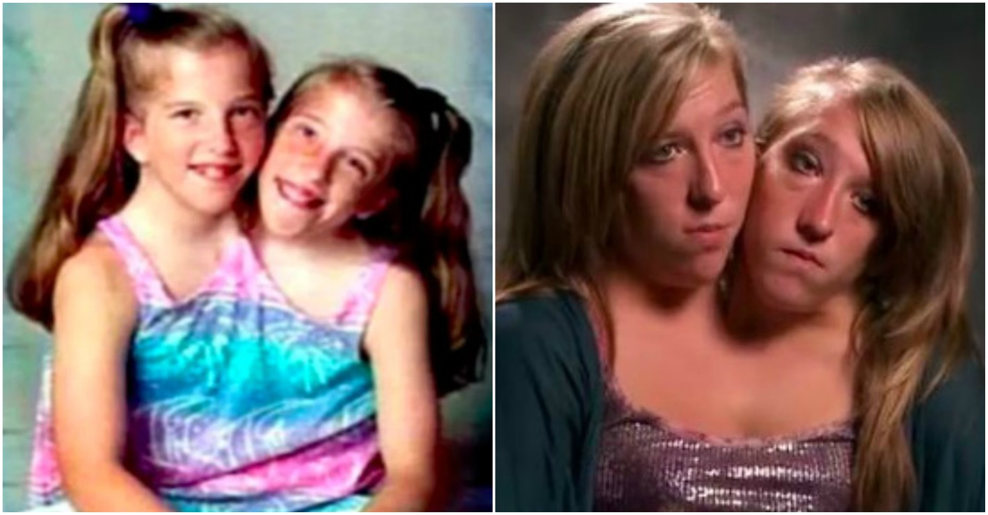 Heres What Conjoined Twins Abby And Brittany Hensel Look Like Today 