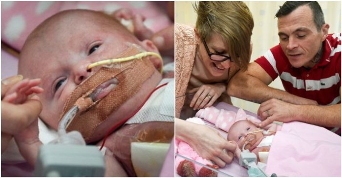 Baby Survives After Being Born With Heart Outside Her Body Viraly